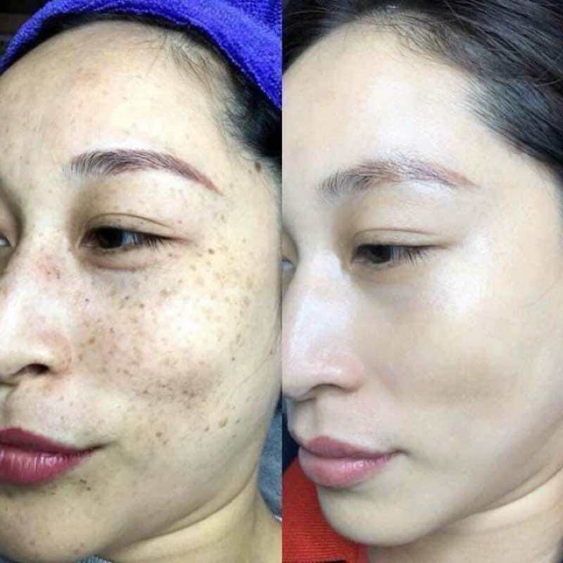From Thailand! Klobetamil G Set highly effective Pekas, Melasma, Dark spots, Pimple remover set. Clobetamil G 7 days result.. 