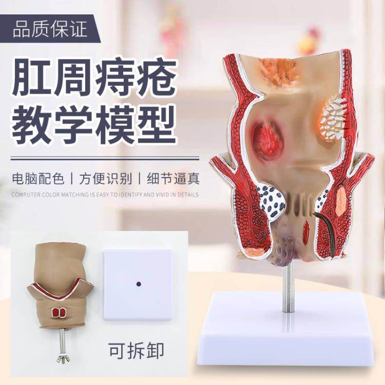Rectal Hemorrhoids Large Intestine Colon Disease Model Internal External Rectal Hemorrhoids Anus Anal Model Rectal Pathology Presyo 1,009 Piso*Libreng Shipping