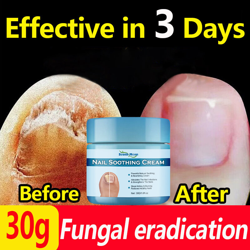 【Quickly effective】Nail repair treatment cream Onychomycosis cream 30g ...