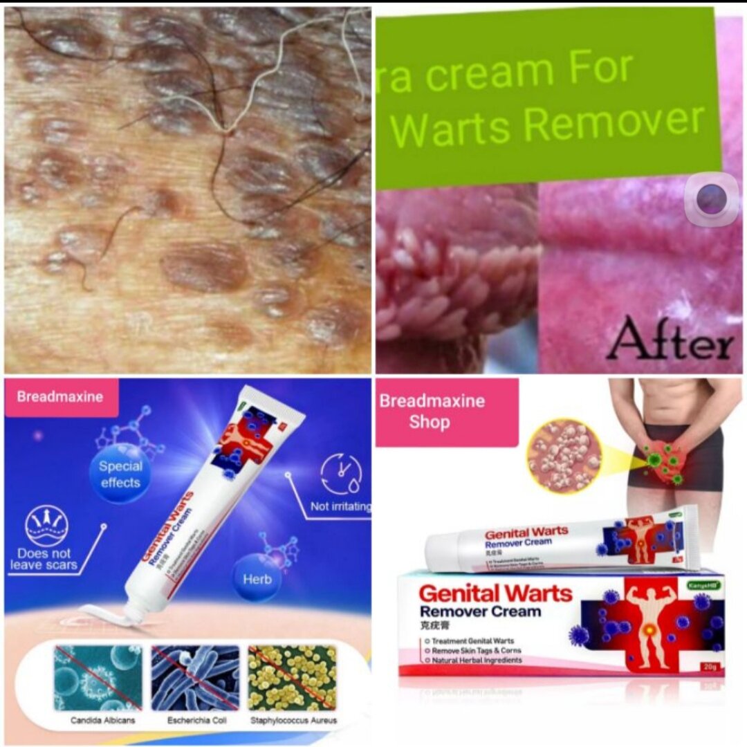 20g Wart Remover Ointment Genital Herpes Genital, 46 OFF