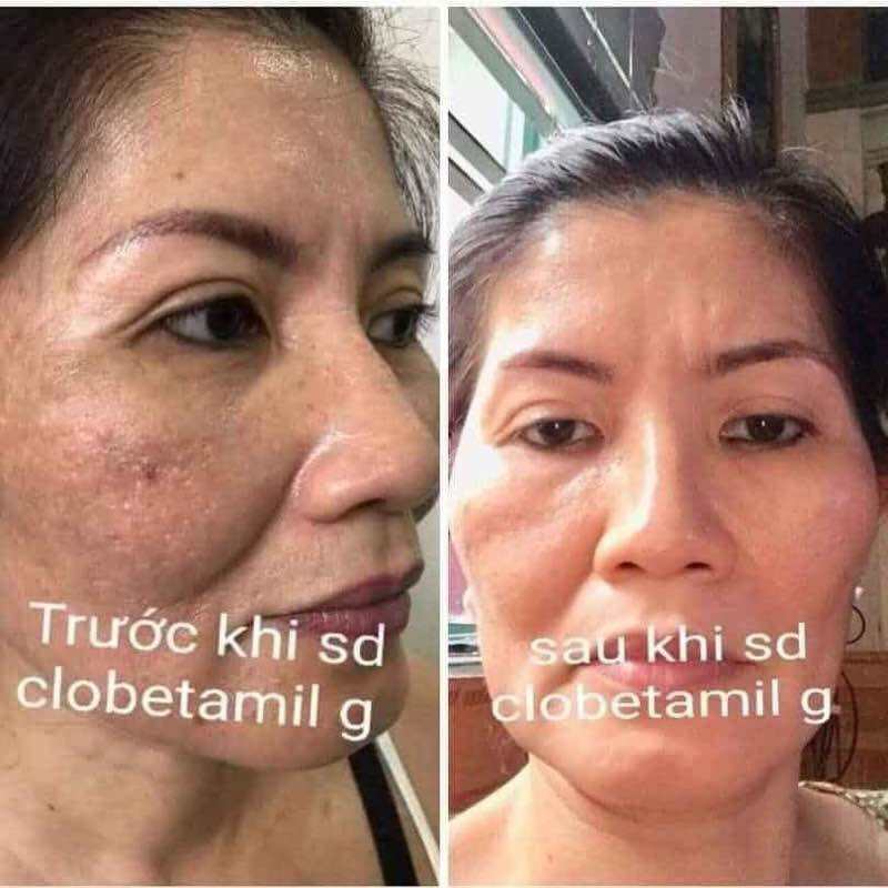 From Thailand! Klobetamil G Set highly effective Pekas, Melasma, Dark spots, Pimple remover set. Clobetamil G 7 days result.. 