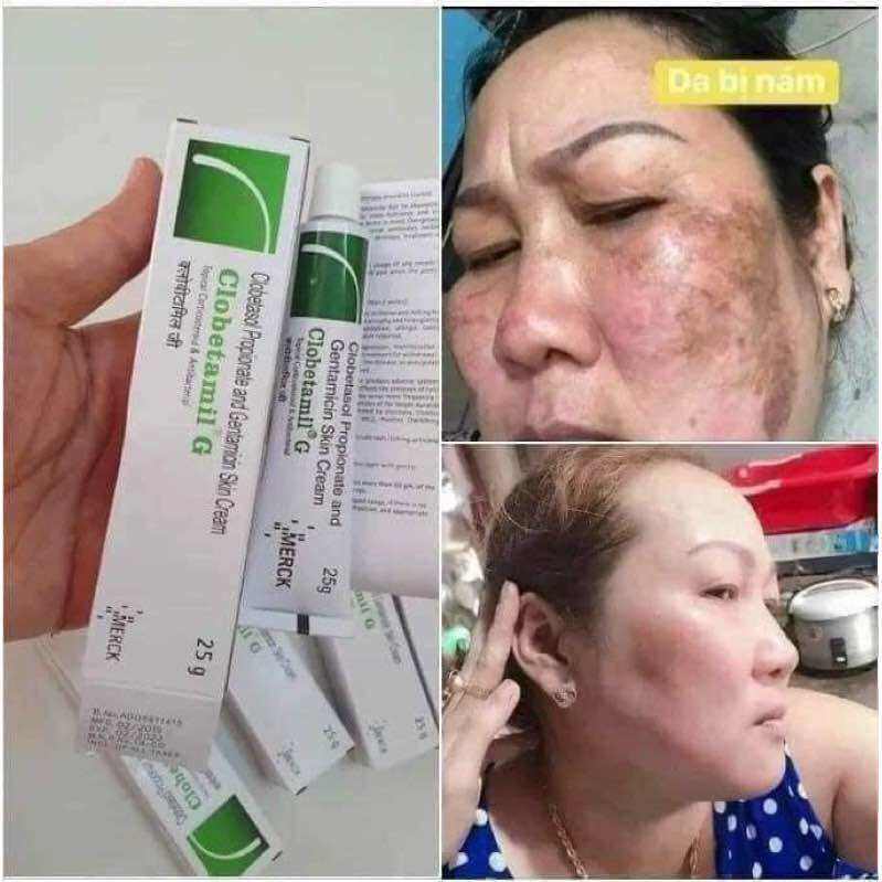 From Thailand! Klobetamil G Set highly effective Pekas, Melasma, Dark spots, Pimple remover set. Clobetamil G 7 days result.. 